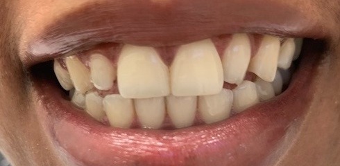 Linet’s Case before treatment