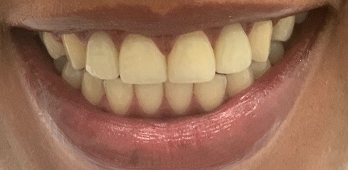 Linet’s Case after treatment