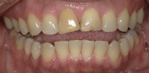 Julia’s Case before treatment