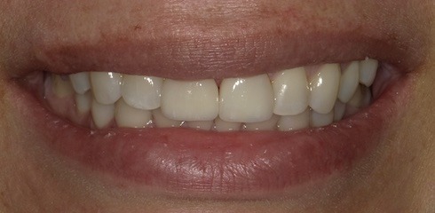 Julia’s Case after treatment