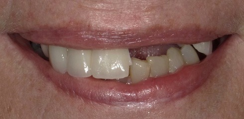Marie’s Case before treatment