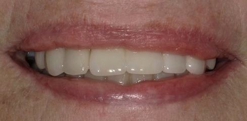Marie’s Case after treatment